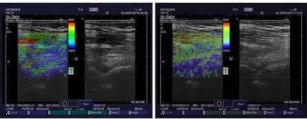 Images of the sonoelastography state before and after fascial