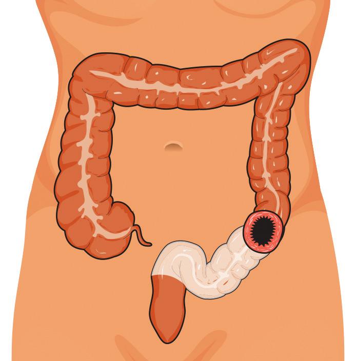 Your bowel movements will naturally empty into the pouch and the frequency and quantity will depend on the type of ostomy you had, your diet and bowel habits prior to surgery.