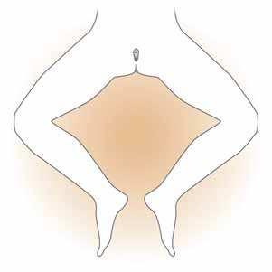 Sterile Intermittent Catheterization Instructions for Women (continued) 4. Position yourself comfortably.