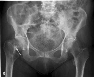 Vitamin D and Calcium Supplementation Do Reduce Hip Fractures in Women Women s Health Initiative RCT n, 36,282 age, 50-79 y F/U, 7 y - 2000 mg Ca + 400 IU vit D 3 or placebo - Ca intake was 1135 and