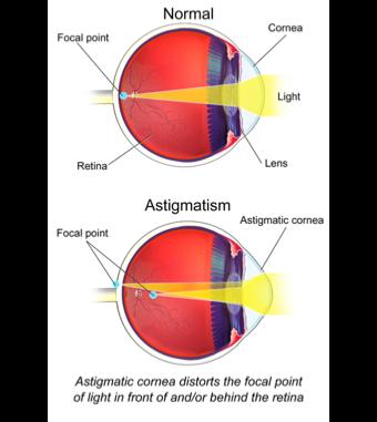 Astigmatism Cornea is shaped like a football rather than a soccer ball