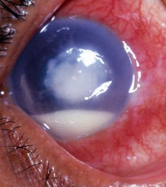 Corneal Ulcer Sight threatening infection of the cornea May be caused by bacteria, virus, or fungus Risk