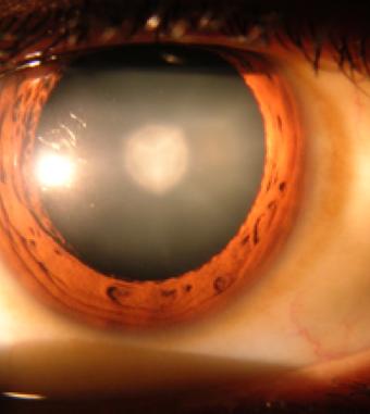 Cataract Cloudy lens The most common cause of