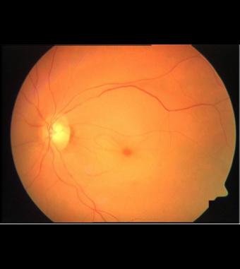 Central Retinal Artery Occlusion Painless, sudden onset of vision loss in one eye Edema causes whitening of retina and