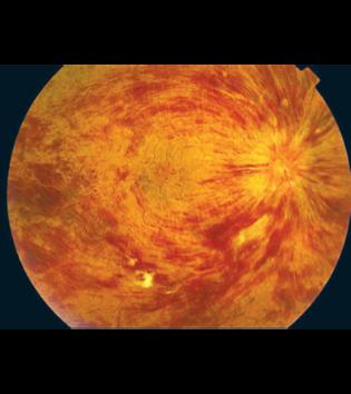 of painless monocular blurred vision Treat with with intravitreal anti-vegf