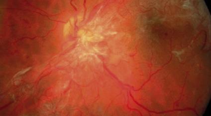 Diabetic Retinopathy Most common cause of vision