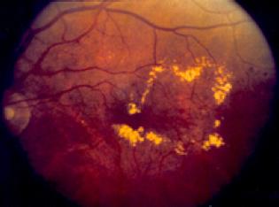 nonproliferative diabetic retinopathy Diabetic