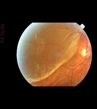 Retinal Detachment Rhegmatogenous From a hole or tear in the retina