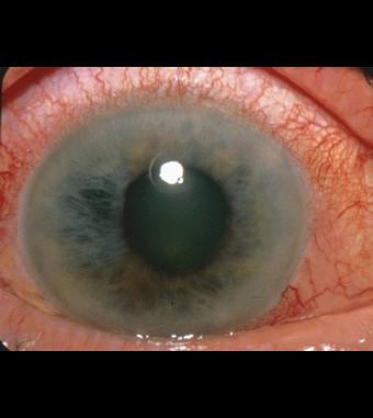 Closed Angle Glaucoma Less common than open angle glaucoma in US, but acutely vision threatening Treatment: cataract removal