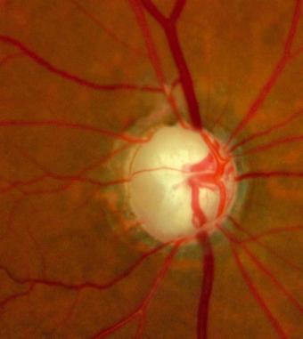Open Angle Glaucoma Glaucoma is second leading cause of blindness in world Optic neuropathy