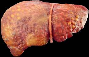 Chemicals Fatty Liver How to protect your liver Get the