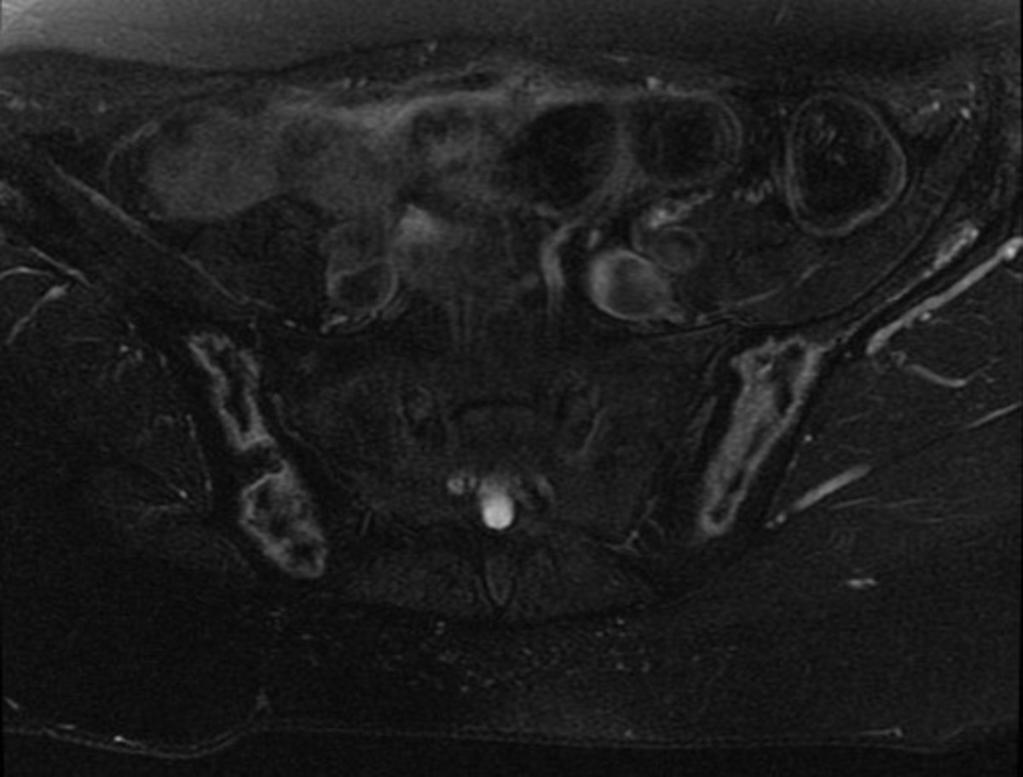 Fig. 6: Axial STIR image showing bilateral