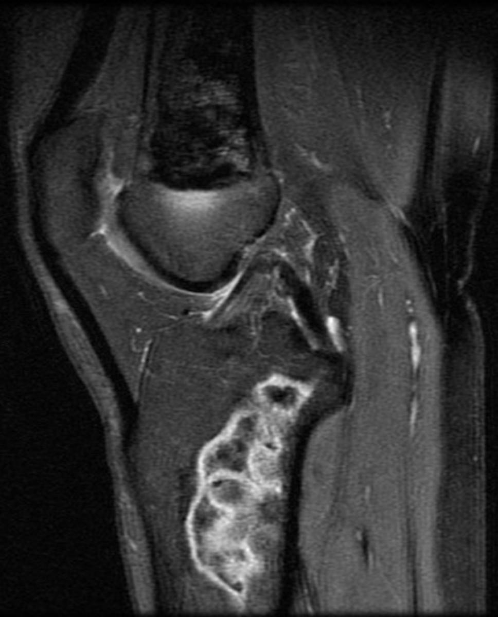 Fig. 10: Sagittal fat saturated T2w image showing medullary osteonecrosis within the distal femur and the proximal tibia.