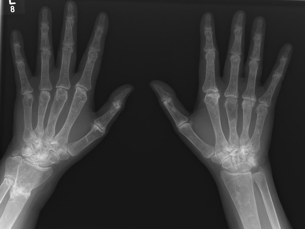 Fig. 13: The hands in Gaucher's disease.
