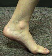 ADULT ACQUIRED FLATFOOT POLL OPEN WHICH OF THESE IS TRUE RE: TRIPLE ARTHRODESIS?
