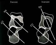 GAIT CYCLE PTT INVERTS HF AFTER FOOTFLAT AXES OF TN / CC NON-PARALLEL FLEXIBLE TO RIGID FOR