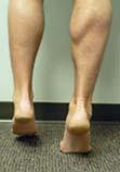STANDING EXAM SYMMETRY VS ASYMMETRY SINGLE LEG HEEL RISE SPECTRUM OF DISEASE