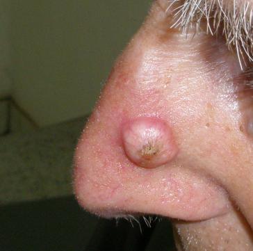 Skin cancer variety Basal cell carcinoma (BCC) ~75 % of the