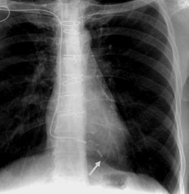 6. Desirable chest X-ray appearance Pacing lead appearance from R