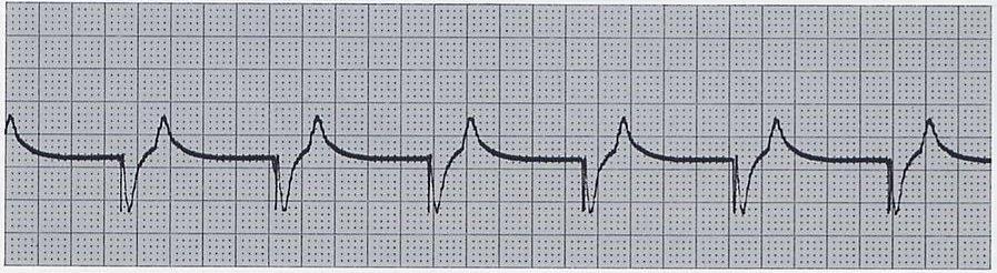 5. Troubleshooting Normal ventricular pacing Ventricular pacing spikes followed by wide QRS complexes 5.
