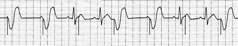 5.2 Ventricular undersensing Ventricular pacing spikes occur regardless of QRS complexes Pacemaker is not seeing intrinsic