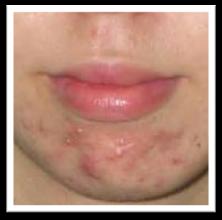 ACNE Acne severity can be graded on the basis of lesion counts The presence of moderate (>10 facial lesions) or