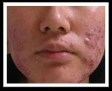 acne vulgaris that is persistent and poorly responsive to topical treatment should prompt investigation