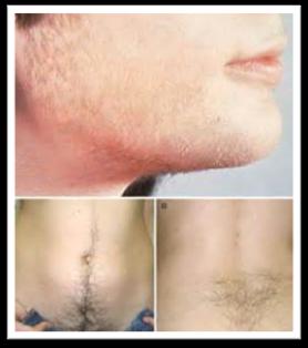 HIRSUTISM Isolated mild hirsutism should not be considered clinical evidence of hyperandrogenism in the early post- menarcheal years when it may be in a developmental phase.
