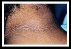 CLINICAL ASSESSMENT: PHYSICAL EXAMINATION presence of acanthosis nigricans, Cushingoid features, blunting of facial features suggestive of acromegaly, and signs of systemic