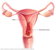 CANCERS IN POLYCYSTIC OVARY SYNDROME Endometrial cancer is increased at least 2-3fold endometrial cancer can begin at a younger age because