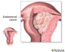 defect in progesterone signaling in the endometrium among cancer patients Risk for ovarian cancer: 2.