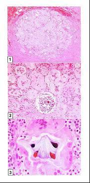 CICI in fibrous marrow Chronic periostitis associated w hyaline bodies: Pulse