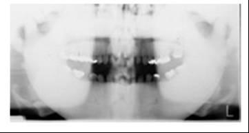 radio-opacity of skull base Greatly reduced sinuses Dental