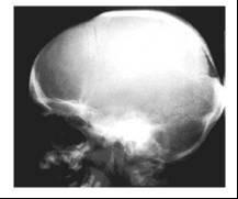 Cleidocranial dysplasia: AD/Sporadic Face, skull &