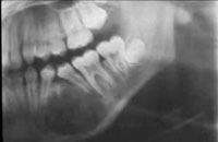 Mand molar & premolar region Slowly growing, painless swelling 20-40ys W-D