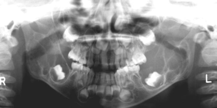 till puberty regress Teeth Multilocular radcy w expansion Radio-opaque