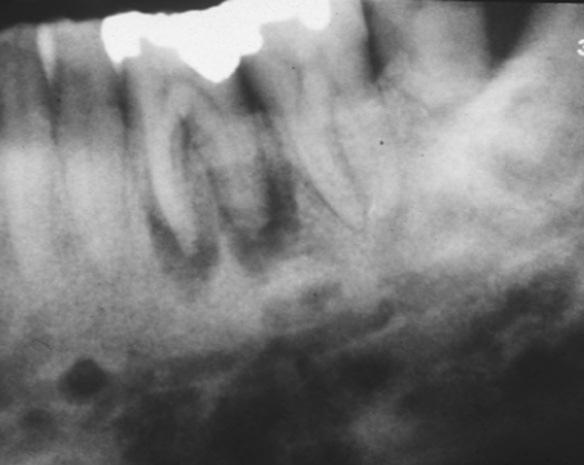 Source of infection Polymicrobial Mandible Severe, throbbing, deep-seated pain Swelling (oedema) Red,
