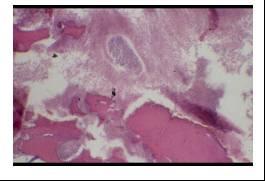 Superimposition of infection on cemento-osseous dysplasia Chronic osteomyelitis w productive