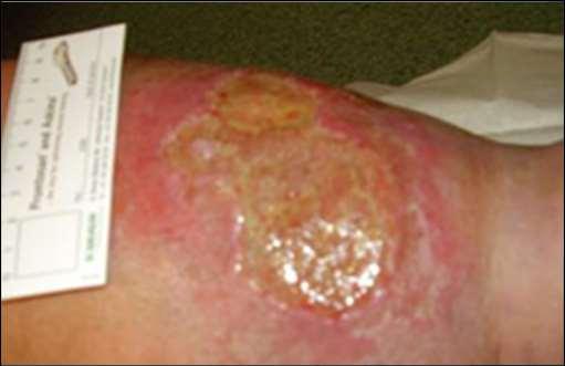PwMASD: Wound Exudate and MASD Periwound skin is not frequently exposed to friction, in contrast to