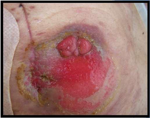 To Prevent Intertriginous Dermatitis (ITD) Peristomal MASD (PMASD) Periwound MASD