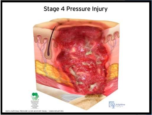 Recognized Etiologies of Chronic Wounds Pressure Injury (pressure and shear) Leg Ulcers (endothelial