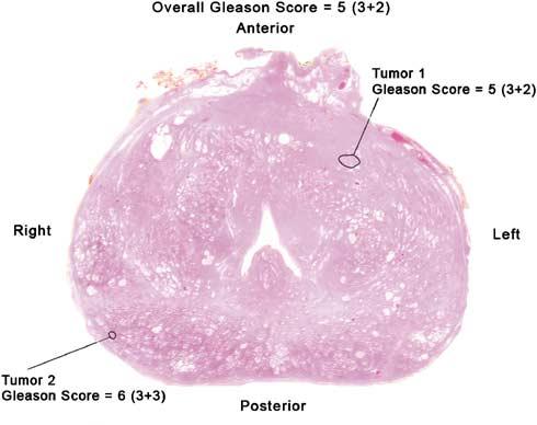 1024 Discussion Figure 1 Whole-mount section of the prostate showing two outlined tumor foci with corresponding individual Gleason scores. Small-volume cancers (o0.