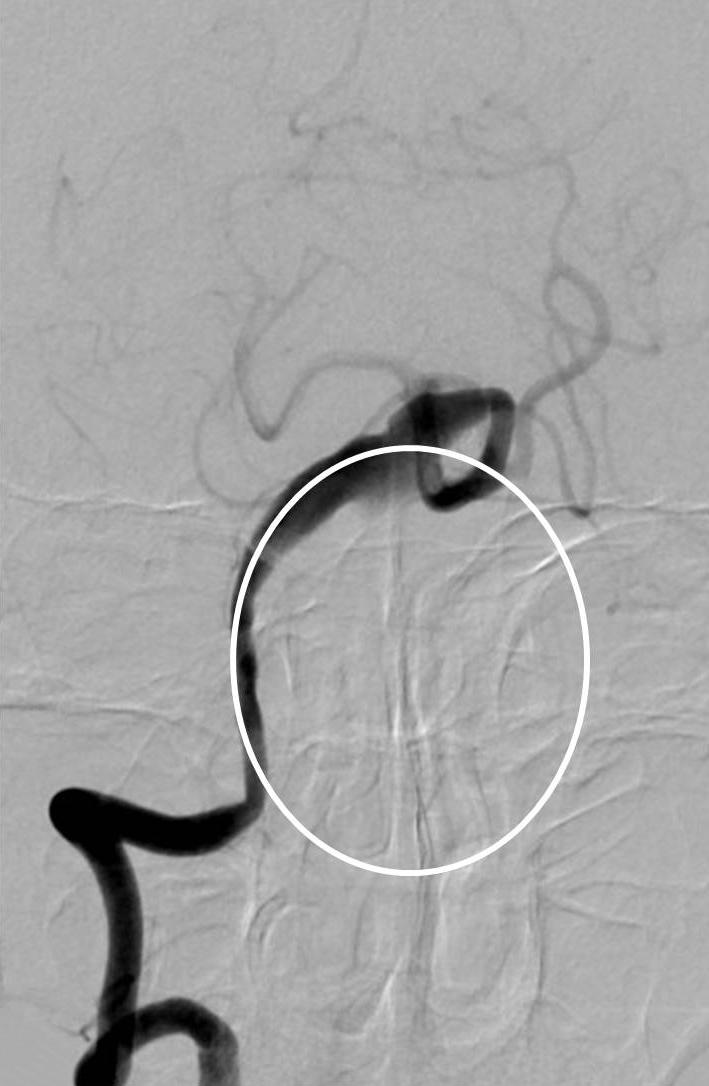 WOOSUNG LEE ET L Fig. 2. Cerebral angiography showed fusiform-like dilatation of the right vertebral artery due to the thrombosed sac. The real contour of the aneurysm is indicated by a white circle.
