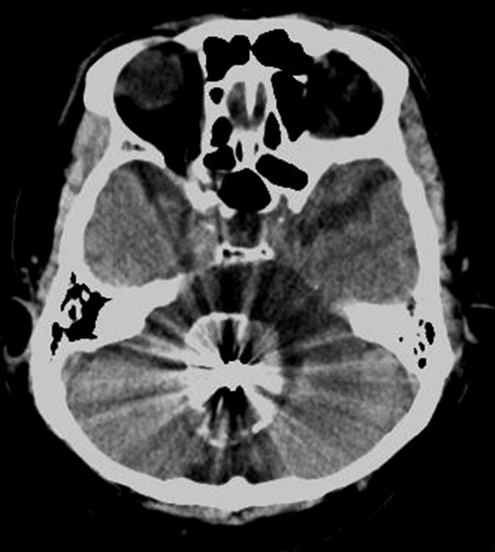 DECOMPRESSIVE SUOCCIPITL CRNIECTOMY FOR THROMOSED GINT NEURYSM D C E Fig. 3. Follow-up radiographic findings.