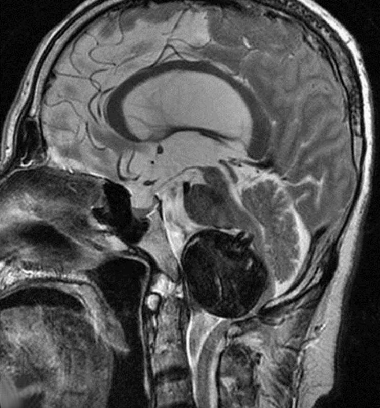 was aggravated. (C) Decompressive suboccipital craniectomy (DSC) with C1 laminectomy was performed.