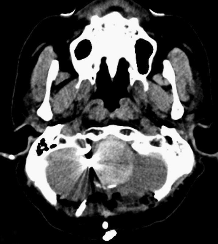 compared to pre-dsc MRI. (E) Microsurgical aneurysmectomy was performed for medulla decompression.