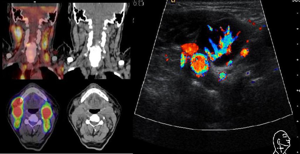Fig. 9: Axial PET-CT scan with increased uptake in multiple paratracheal nodes, located at level