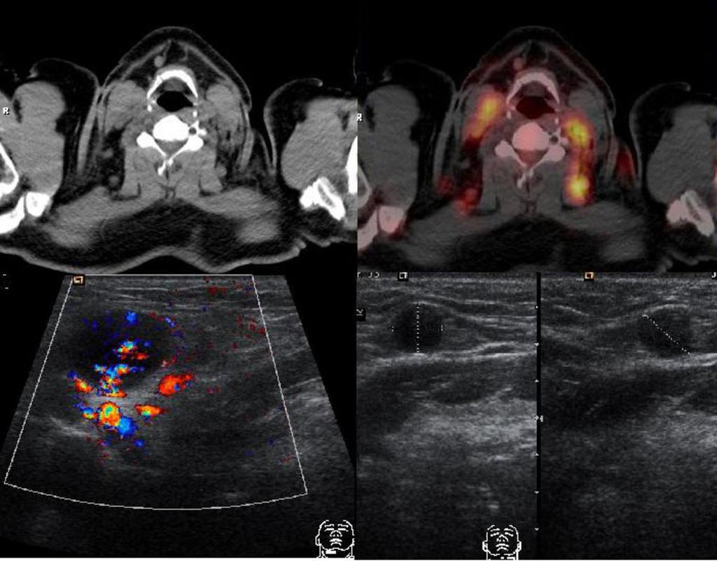 Fig. 4: Axial PET-CT scan reveals Cervical lymph nodes located in levels I and Ib, in a patient diagnosed with diffuse small