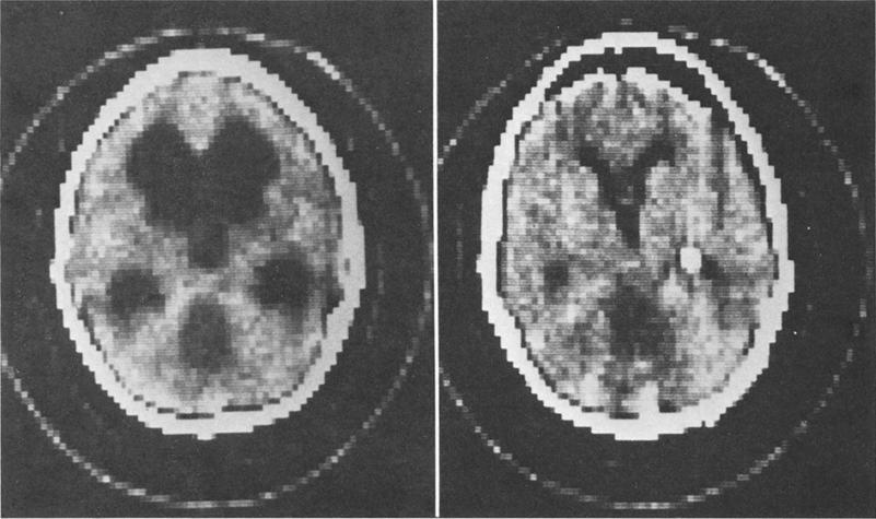 Subgaleal shunt for ventrieular and subdural drainage FIG 2. Computerized tomography (CT) scans of a 9-year-old girl with a left cystic cerebellar astrocytoma.