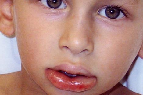 Angioedema can cause severe